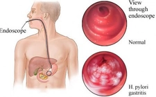 Gastrit Tedavisi Gastrit Nasıl Tedavi Edilir? Gastrit Tedavisi Gastrit Nasıl Tedavi Edilir?