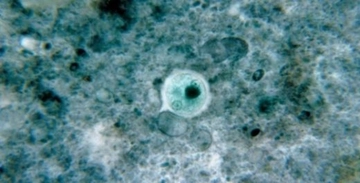 Amip Tedavisi Amip Nasıl Tedavi Edilir? Amip Tedavisi Amip Nasıl Tedavi Edilir?