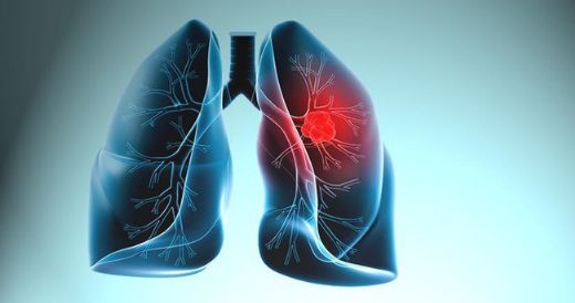 Akciğer Kanseri Bitkisel Tedavi