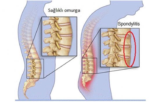 Ankilozan Spondilit Tedavisi