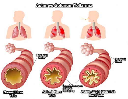 Astm Tedavisi