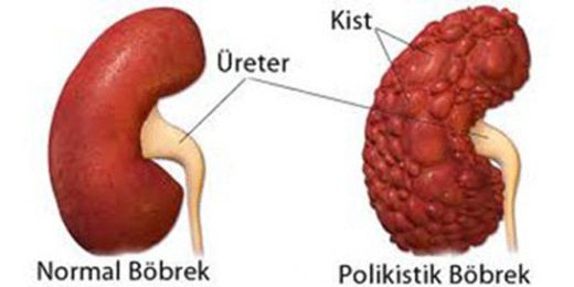 Bbrek Kisti Tedavisi