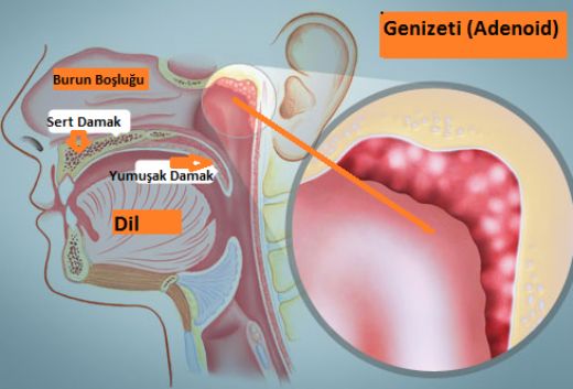 Geniz Eti Tedavisi