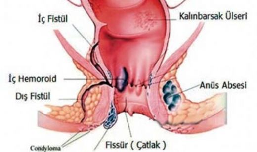 Hemoroid Tedavisi