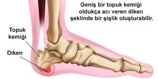 brahim Saraolu Topuk Dikeni Tedavisi