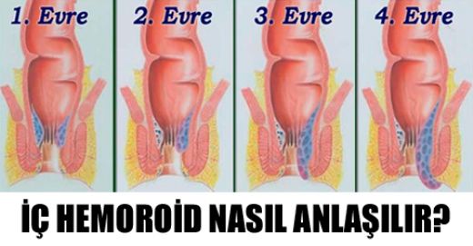  Hemoroid Tedavisi