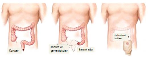 Kaln Barsak Kanseri Tedavisi
