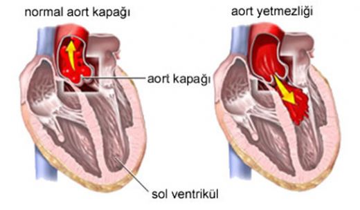 Kalp Yetmezlii Tedavisi