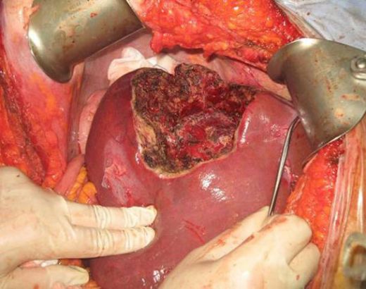 Karaciğerde Kist Tedavisi