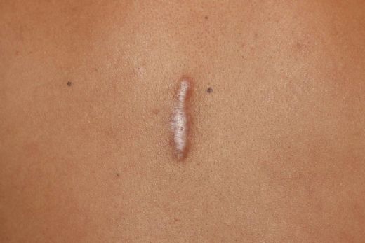 Keloid Tedavisi