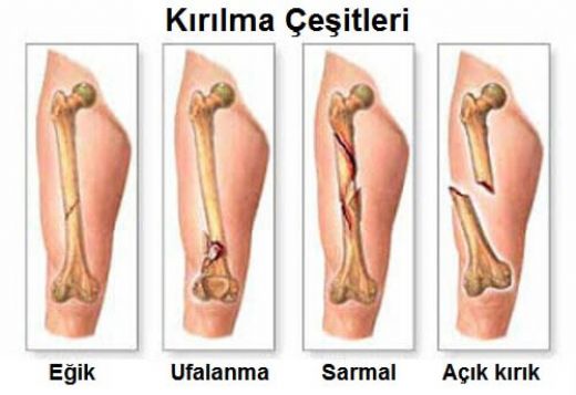 Kemik Kanseri Tedavisi