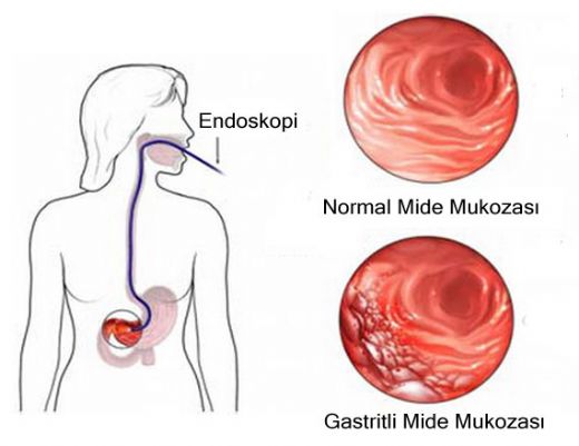 Kronik Gastrit Tedavisi