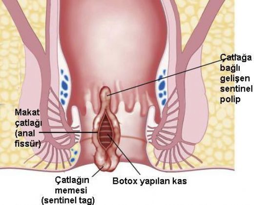 Makatta atlak Tedavisi