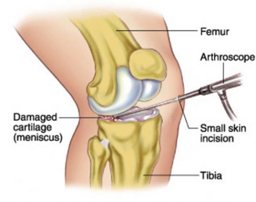Menisks Tedavisi