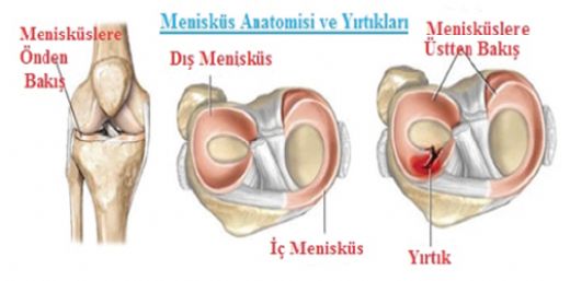 Menisks Yrtlmas Tedavisi