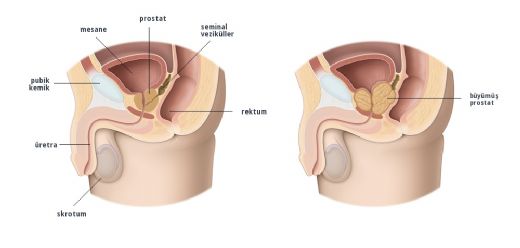 Prostat Bymesi Tedavisi