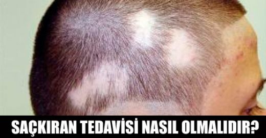 Sakran Tedavisi