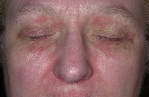 Seboreik Dermatit Tedavisi