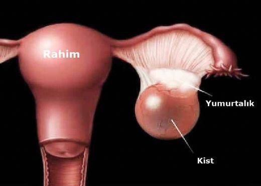 Yumurtalk Kisti Tedavisi