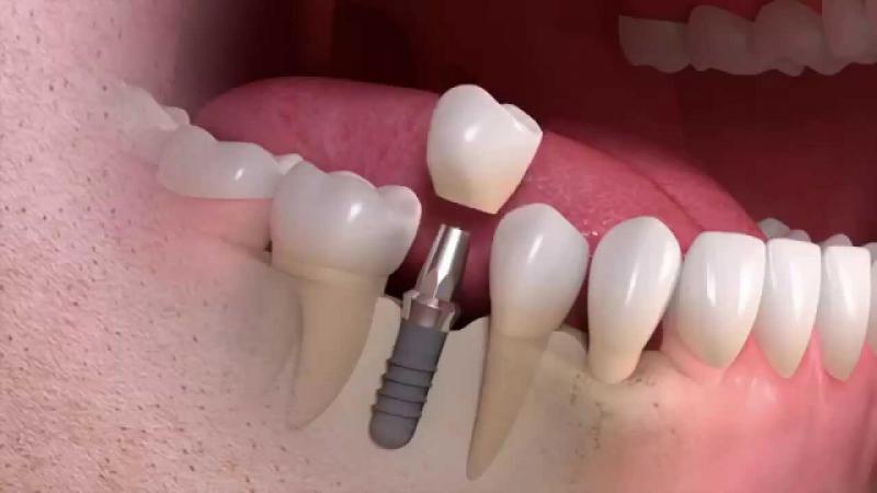 İmplant Diş Tedavisi