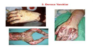 3 Derece Yanık Tedavisi 3 Derece Yanık Nasıl Tedavi Edilir? 3 Derece Yanık Tedavisi